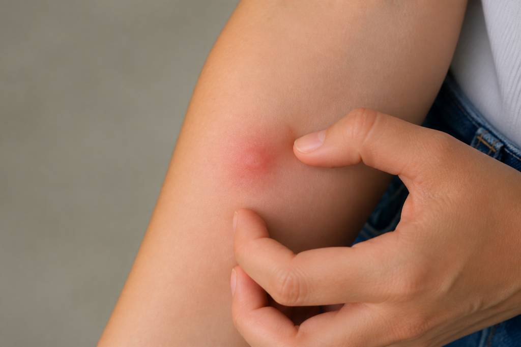 Bouton qui gratte comme une piqûre de moustique : causes et solutions